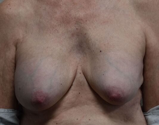 Breast Implant Removal Case 70 - Before