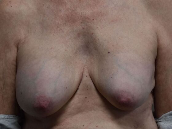 Breast Implant Removal Case 70 - Before