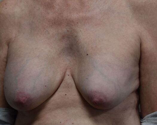 Breast Implant Removal: Case 70 - Before
