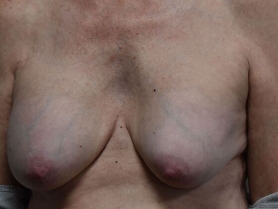 Breast Implant Removal: Case 70 - Before