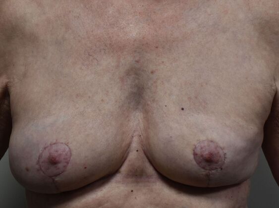 Breast Implant Removal Case 70 - After