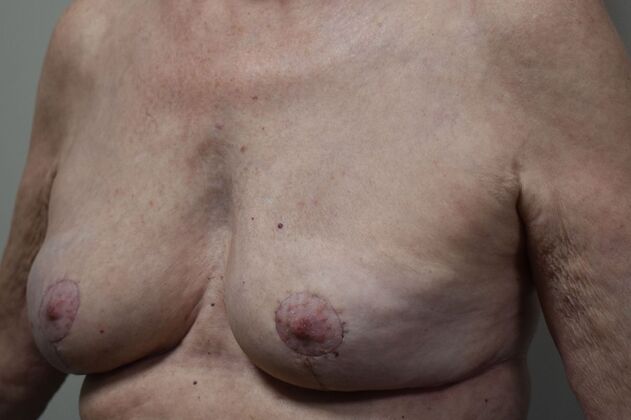 Breast Implant Removal: Case 70 - After