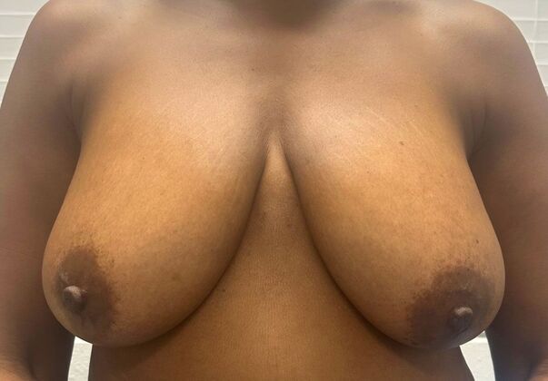 Breast Lift (Mastopexy): Case 272 - Before