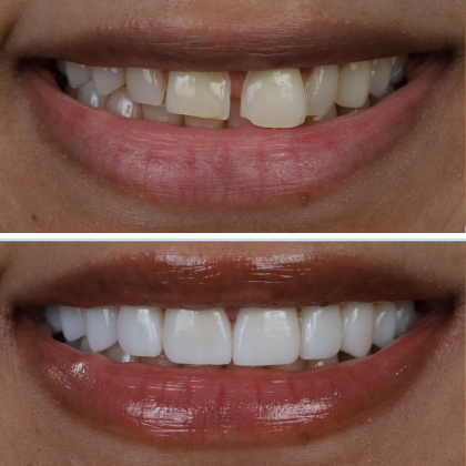 Minimal Prep Porcelain Veneers Shina - Before