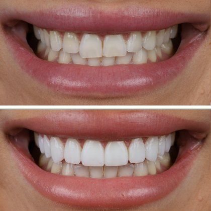 No Prep Porcelain Veneers Daria Rae - Before