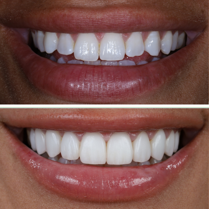 No Prep Porcelain Veneers Toni - Before