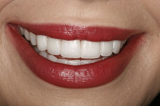 Dental Crowns & Veneers: Case 2 - Before