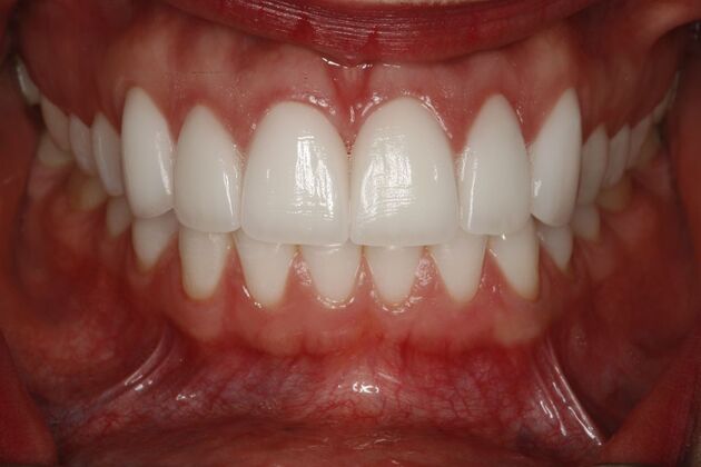 Dental Crowns & Veneers: Case 2 - After