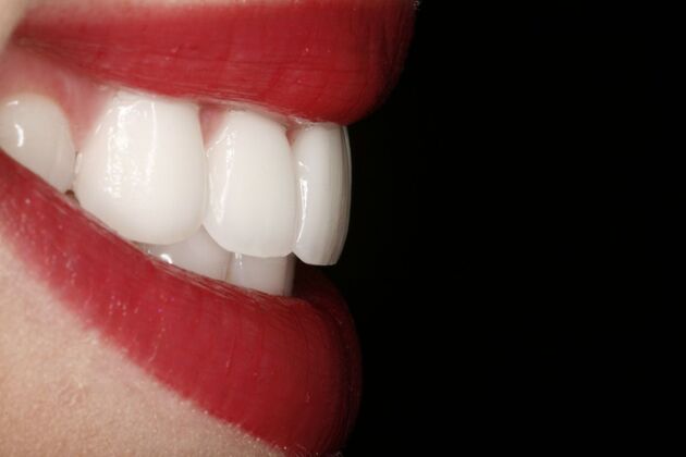 Dental Crowns & Veneers: Case 2 - After