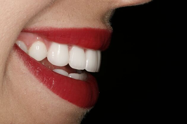 Dental Crowns & Veneers: Case 2 - After