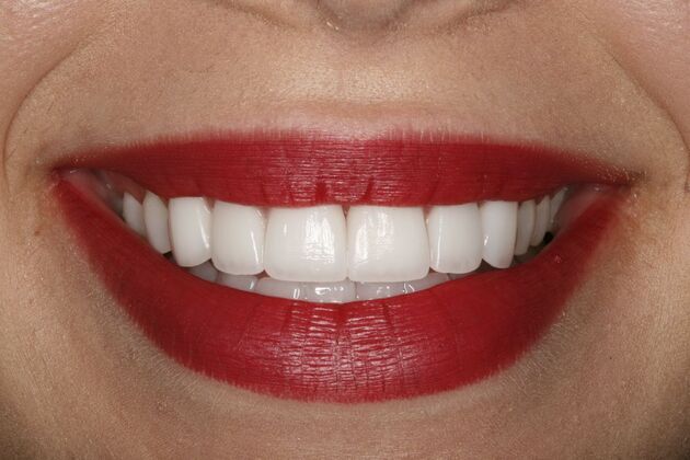 Dental Crowns & Veneers: Case 2 - After