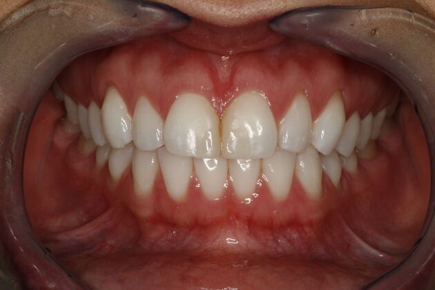 Dental Crowns & Veneers: Case 2 - Before