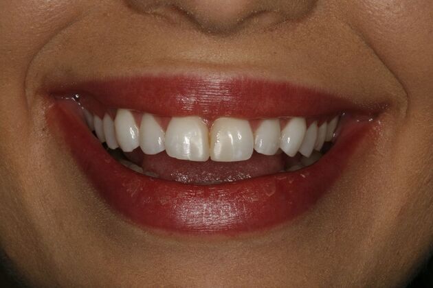 Dental Crowns & Veneers: Case 2 - Before