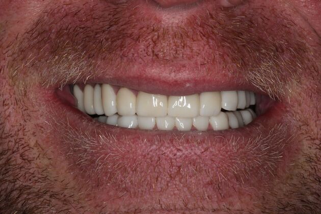 Full Mouth Reconstruction: Case 5 - After