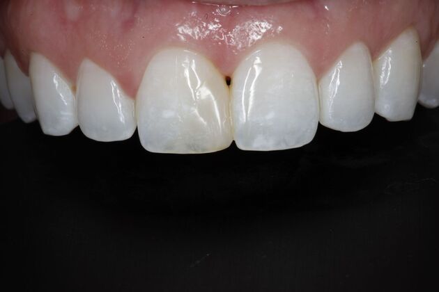 Bonding: Case 1 - Before