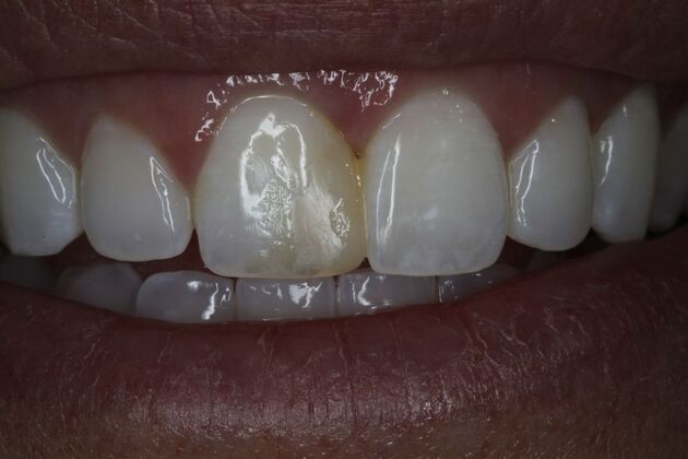 Bonding: Case 1 - Before