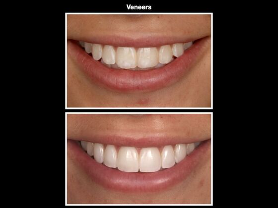 Veneers and Crowns Case 1