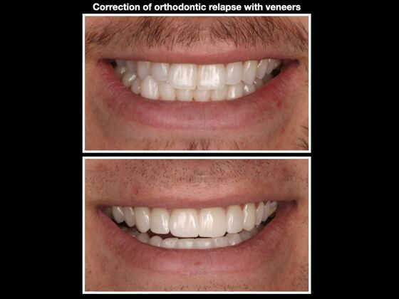Veneers and Crowns Case 2