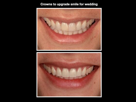 Veneers and Crowns Case 3