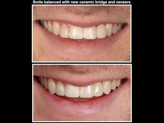 Smile Makeover Case 3