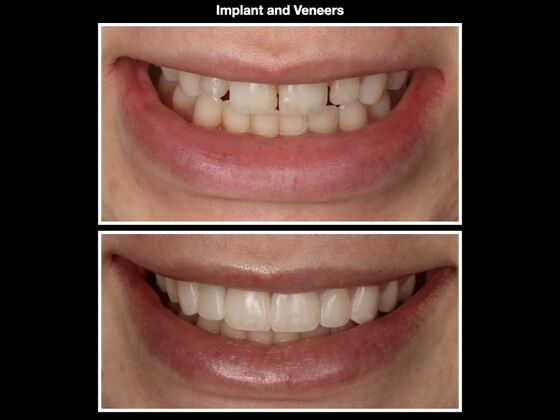 Smile Makeover Case 2
