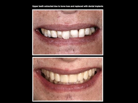 Dental Implants Case 1