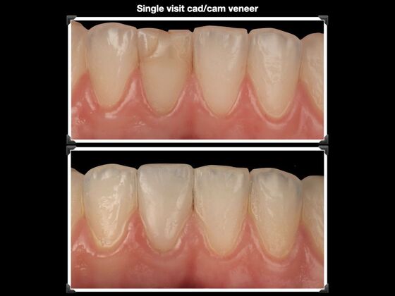 Veneers and Crowns Case 4