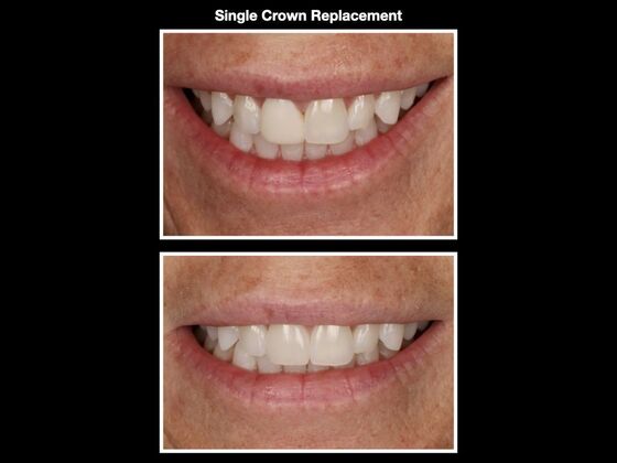 Veneers and Crowns Case 5