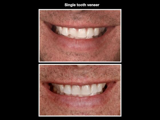 Veneers and Crowns Case 6