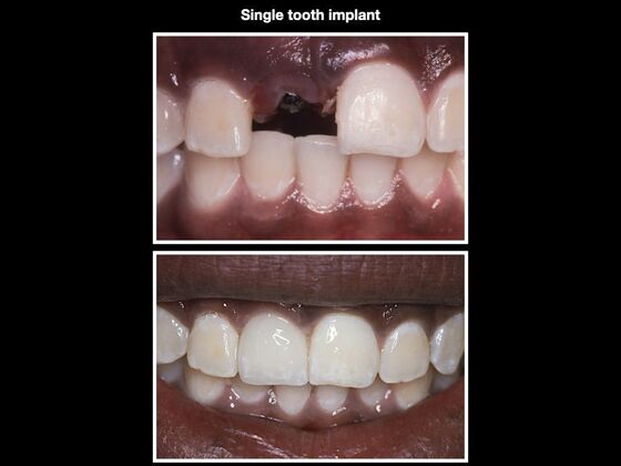 Dental Implants Case 2