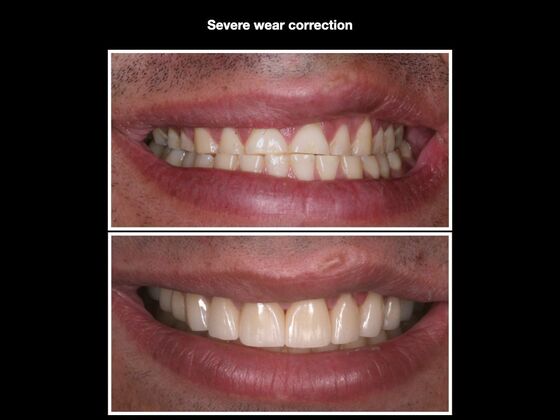 Smile Makeover Case 1