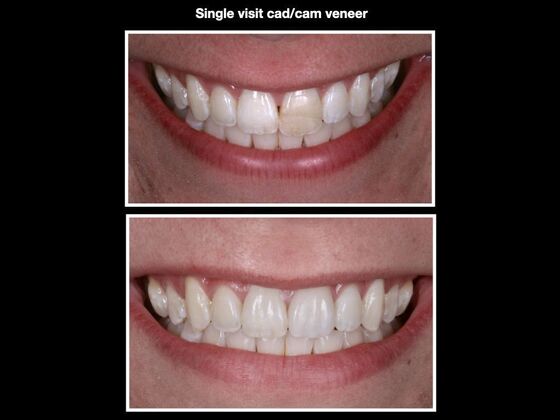 Veneers and Crowns Case 7