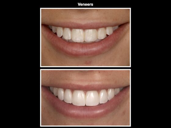 Veneers and Crowns Cases