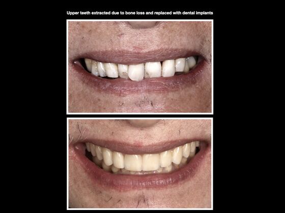 Dental Implants Cases