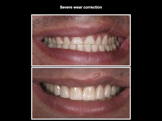 Smile Makeover Cases