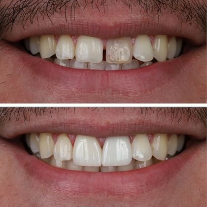Minimal Prep Porcelain Veneers: Wladimer - Before