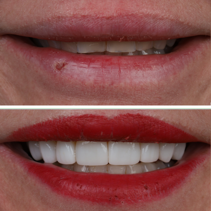 SmileSculpt Veneers Heather - Before