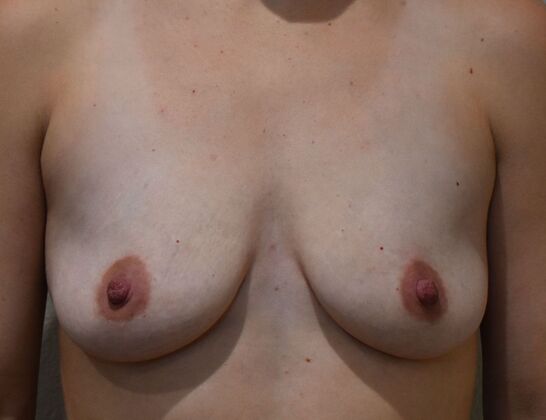 Breast Augmentation Case 822 - Before