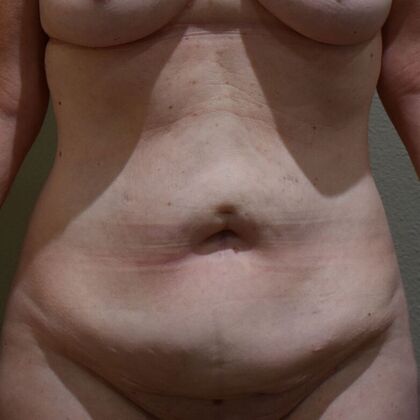 Tummy Tuck (Abdominoplasty): Case 591 - Before