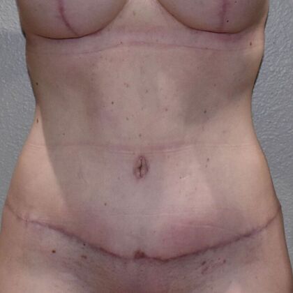 Tummy Tuck (Abdominoplasty): Case 591 - After