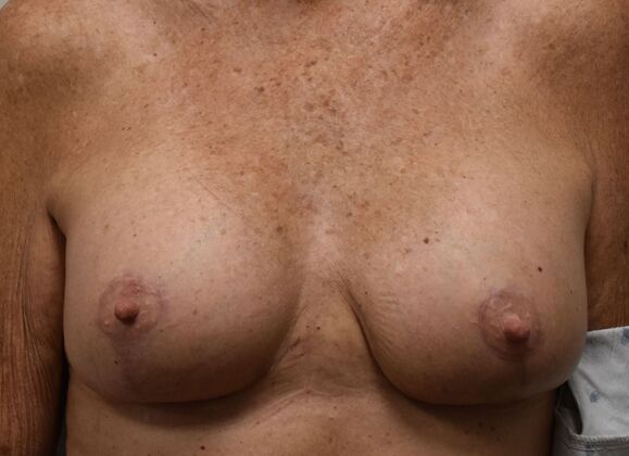 Breast Augmentation w/ Lift: Case 649 - After