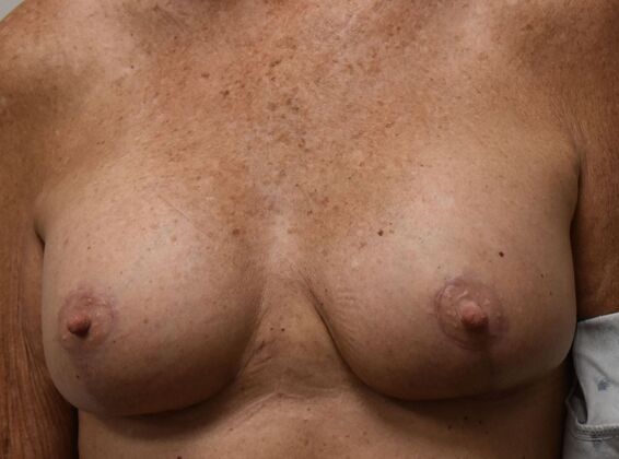 Breast Augmentation w/ Lift: Case 649 - After