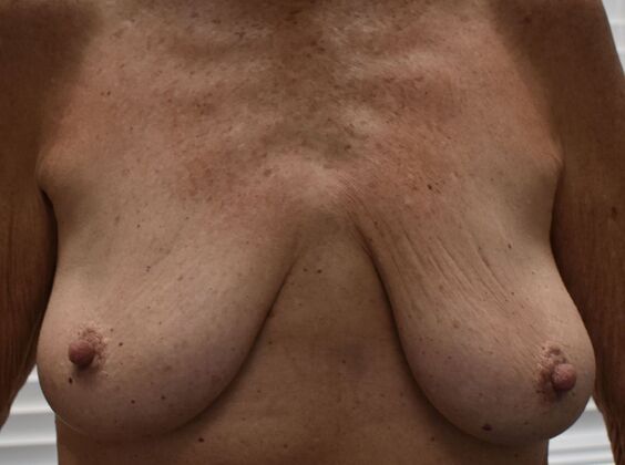 Breast Augmentation w/ Lift: Case 649 - Before