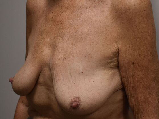 Breast Augmentation w/ Lift: Case 649 - Before