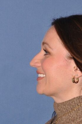 Rhinoplasty: Bump and hanging tip in a lovely woman - Before