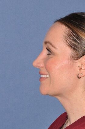Rhinoplasty: Bump and hanging tip in a lovely woman - After