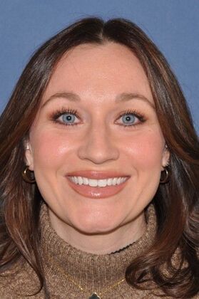 Rhinoplasty: Bump and hanging tip in a lovely woman - Before
