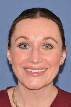 Rhinoplasty: Bump and hanging tip in a lovely woman - After