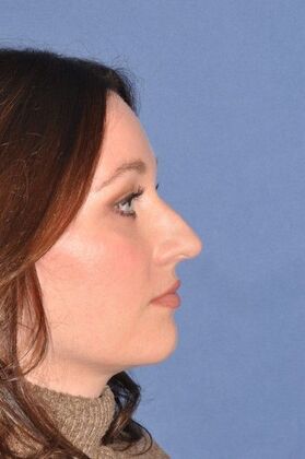 Rhinoplasty: Bump and hanging tip in a lovely woman - Before