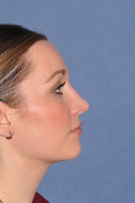 Rhinoplasty: Bump and hanging tip in a lovely woman - After